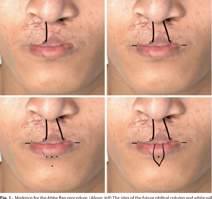 Palate cleft priority aapc ear hard