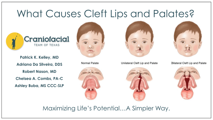 Palate cleft furlow reconstruction defect opposing plasty surgery