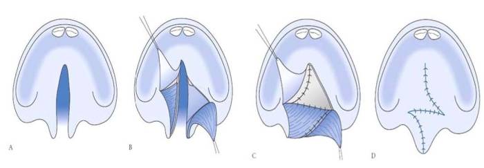 Cleft lip repair cpt code