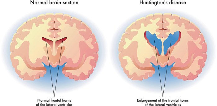 Nursing diagnosis for huntington's disease